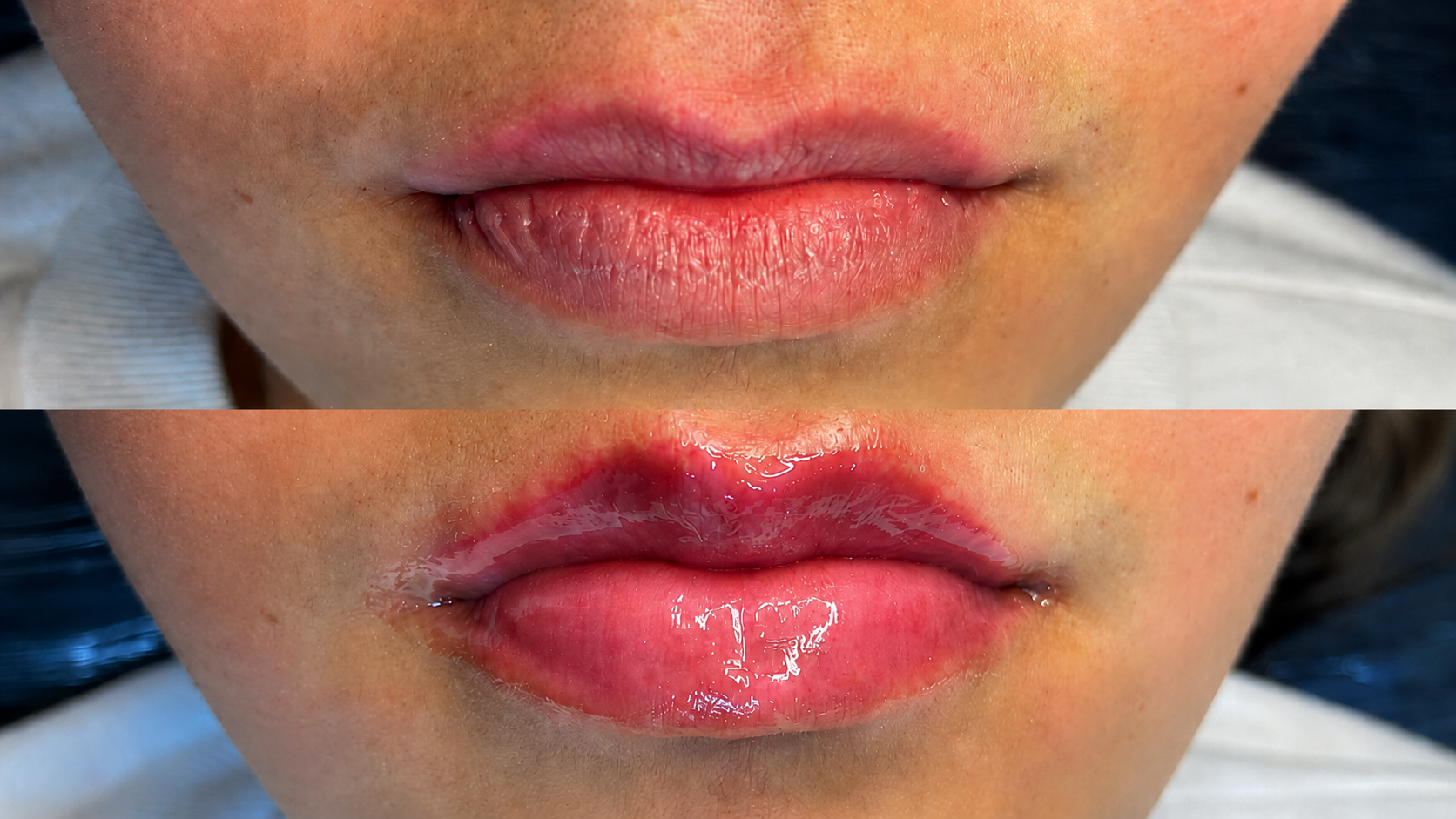 Antes e depois de hidragloss 2