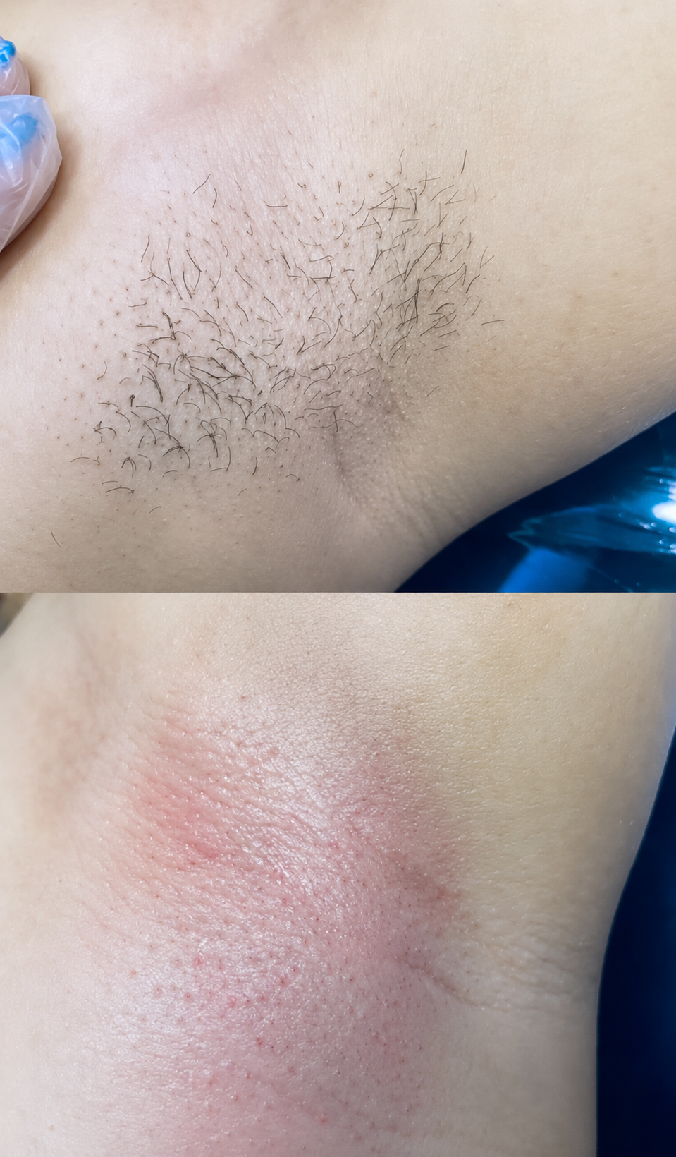 Resultado de depilacao